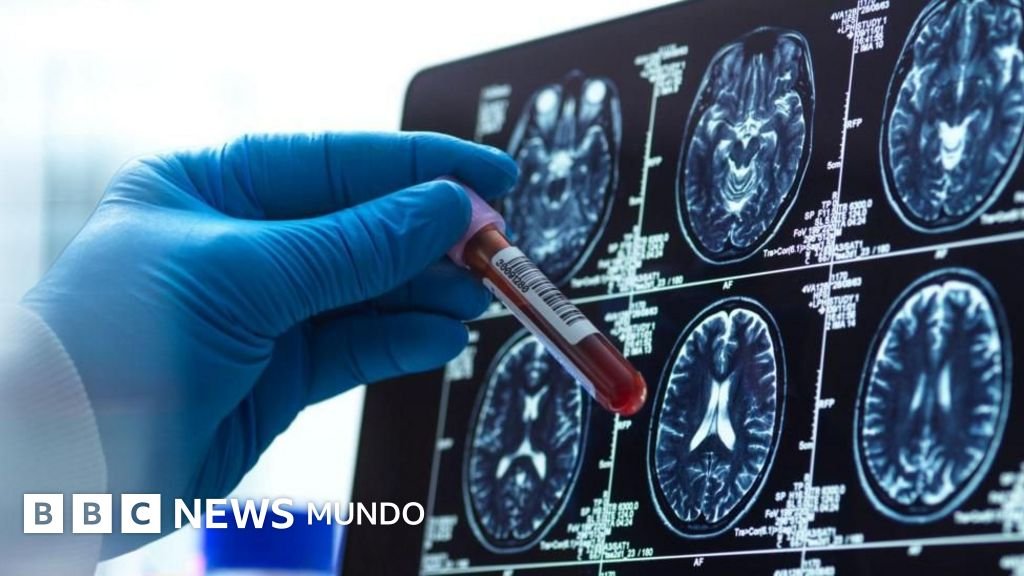 Cuatro innovaciones prometedoras en la lucha contra el Alzheimer en 2023
