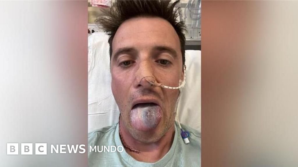 Casi pierdo la lengua a causa de un cáncer y ahora advierto a otros hombres sobre el peligro del virus del papiloma humano.