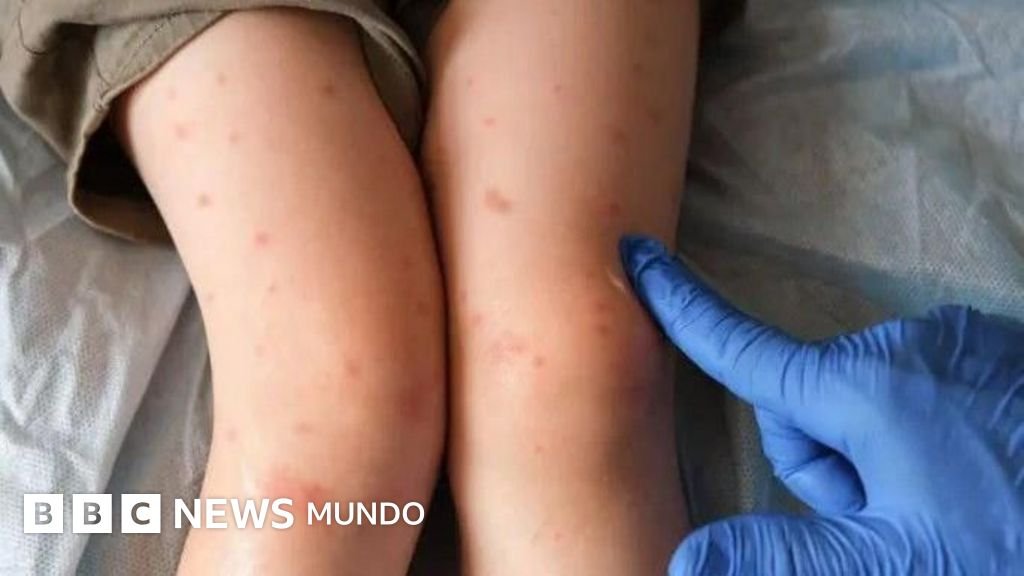 El condado en EE.UU. donde el sarampión se manifiesta como una nueva pandemia.